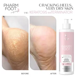 ג'ל קלאוס - ממיס עור קשה לפדיקור 300 מ"ל - PHARM FOOT